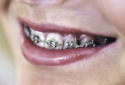 Smile With Braces